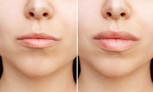 Lippenaufpolsterung - Perfect Lips
